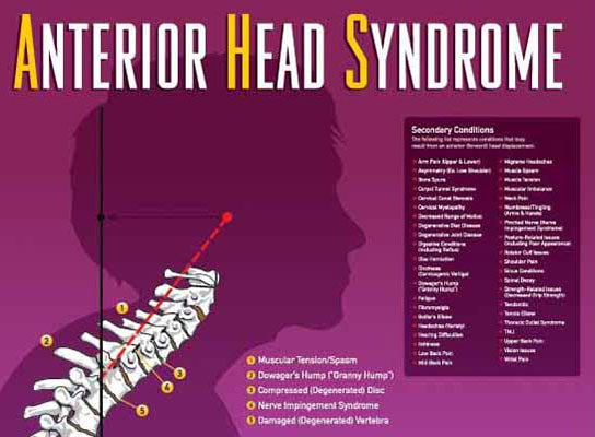 Anterior Head Syndrome